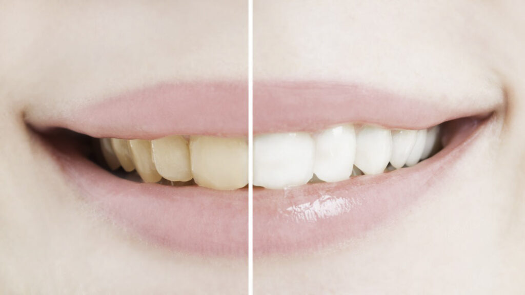 Before and after picture of teeth whitening. 