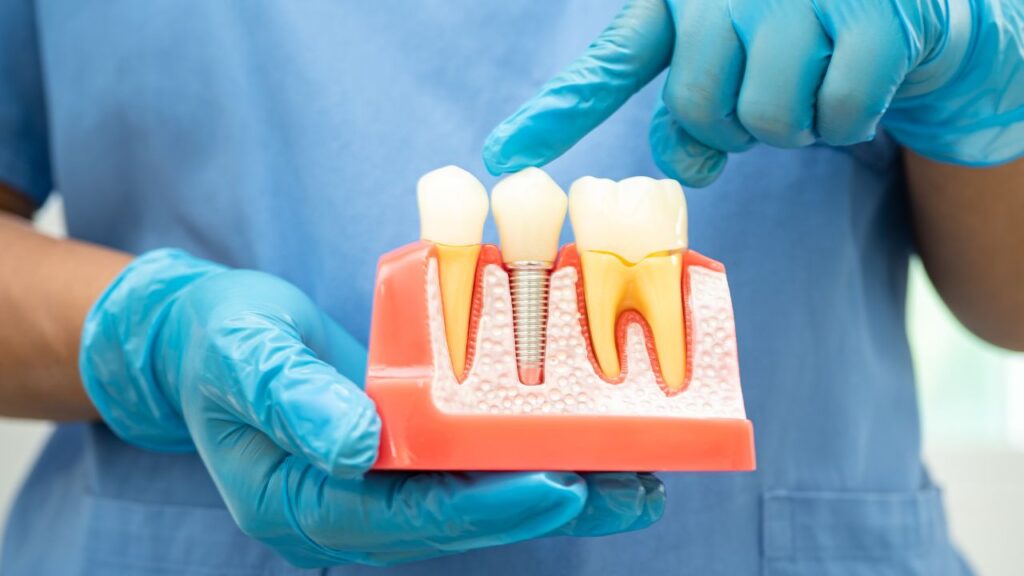 Dental implant, artificial tooth roots into jaw, root canal