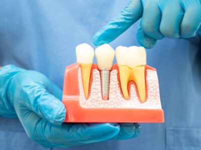 Dental implant, artificial tooth roots into jaw, root canal